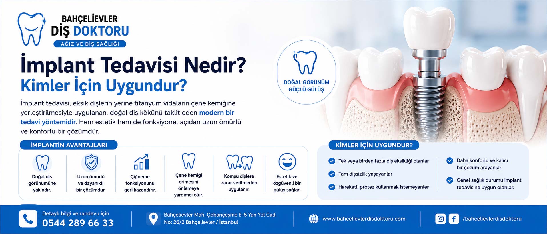 İmplant Tedavisi Nedir? Kimler ...