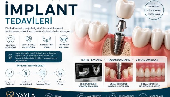 İmplant Tedavileri